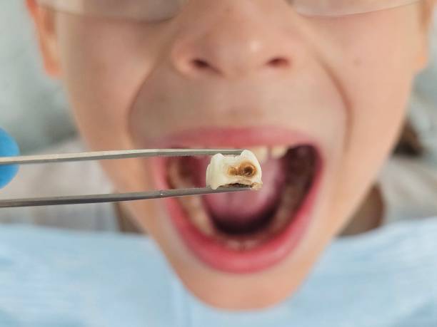 Best Emergency Dentist for Knocked-Out Tooth in River Ridge, FL